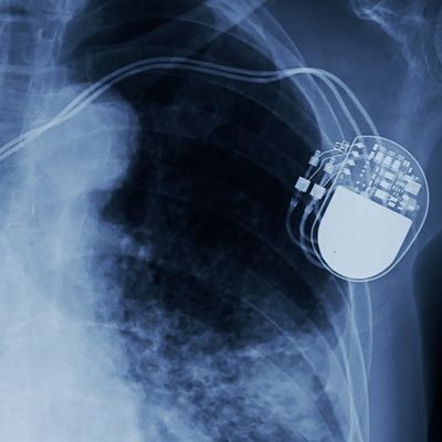 URMC Heart Researchers Launch $27M ICD Study 