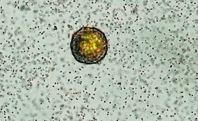 Minsoo-Kim_Neutrophils-attack-tumor 002 - still shot