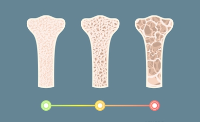 Eliseev osteoporosis stages