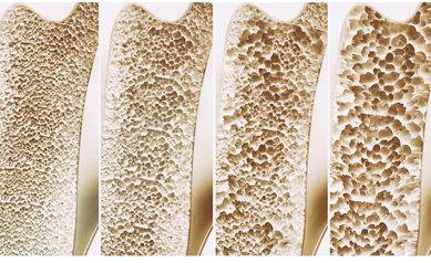 Eliseev progression of bone loss