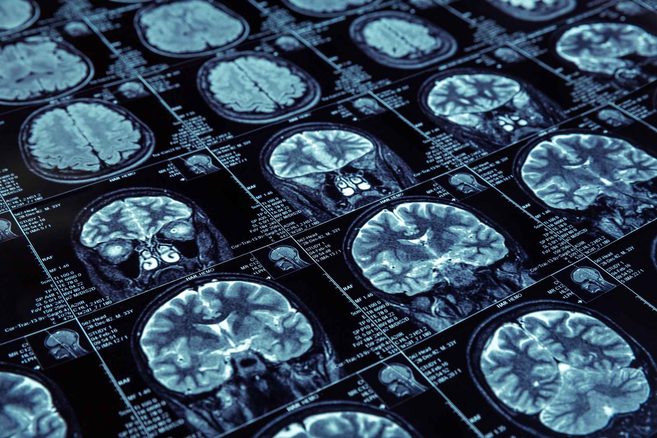 Alzheimer's brain images