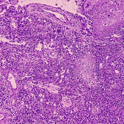 Kidney cancer_11zon