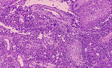A Multidisciplinary Approach to Kidney Cancer Care