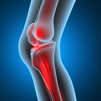 bone infection image
