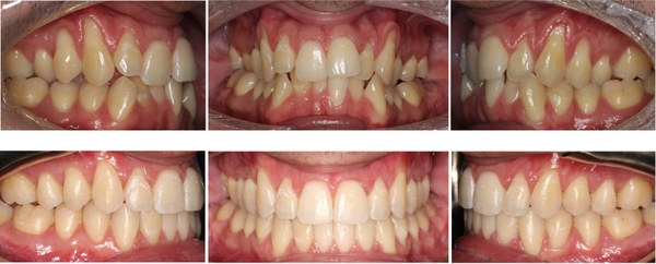 gum recession pic