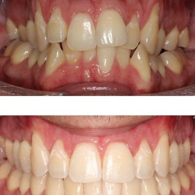gum recession pic