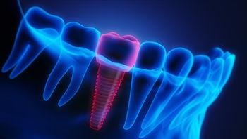 A 3-D model of a lower jaw, with gums and teeth shown in blue. A dental implant is screwed into the jaw and emphasized in red.