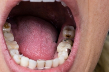 An open mouth, showing multiple teeth with cavities and fillings.