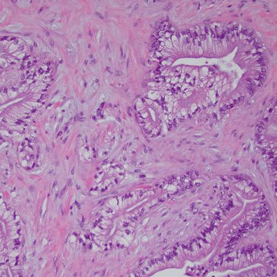 PDAC 20x - pancreatic cancer 2 - from URMC pathology - Nov 2023