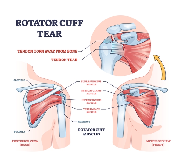 diagram of a rotator cuff tear
