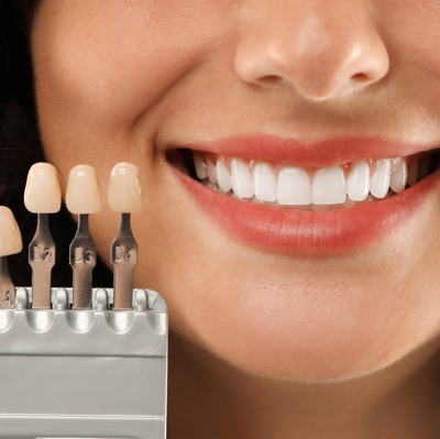 Should I Get Veneers? Consider These 5 Things First