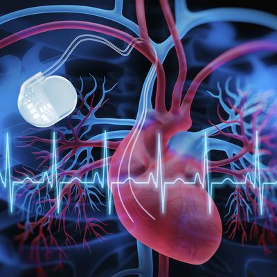 Pacemaker vs. Defibrillator: How We Choose What’s Right for Your Heart