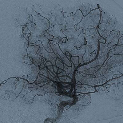 Neuroscience and Innovation: Redefining Stroke Care & Recovery