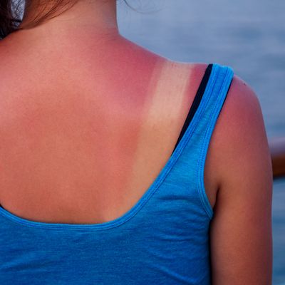 Can One Severe Sunburn Increase Your Cancer Risk?
