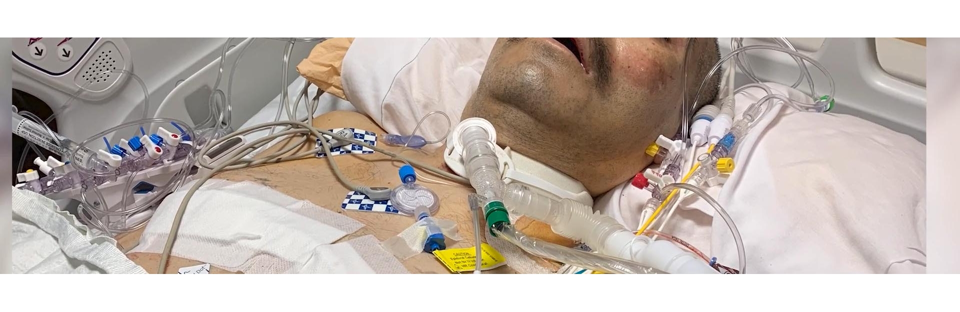 double-lung-surgery