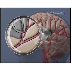 New medication may reduce chances of a second clot-caused stroke without bleeding risk