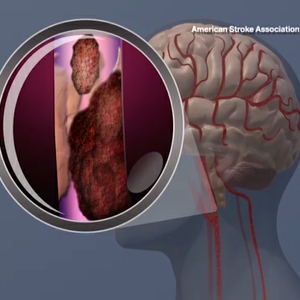 Blood clot breaking off in carotid artery