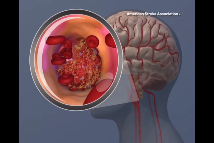 Blood clot formation in carotid artery