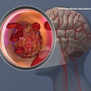 Blood clot formation in carotid artery