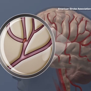 Clot-busting meds may be effective up to 24 hours after initial stroke symptoms 