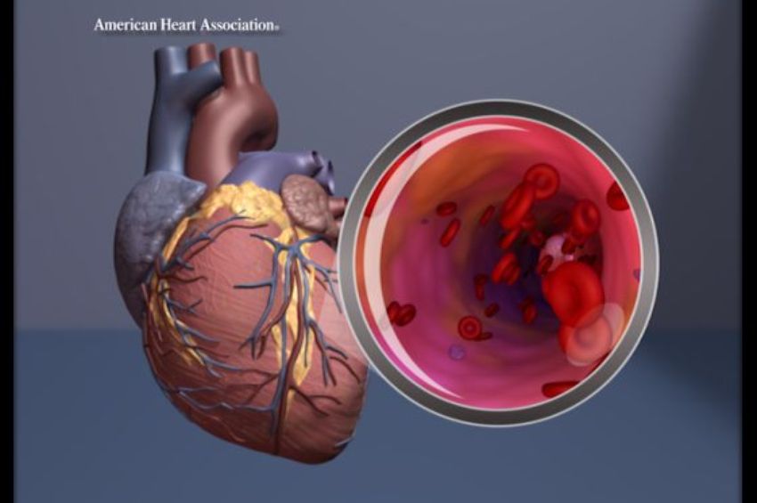 Still top cause of death, the types of heart disease people are dying from is changing