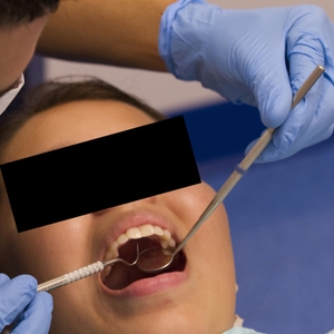 Dental exam (V)