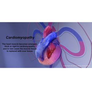 New medication may treat underlying causes of hypertrophic cardiomyopathy