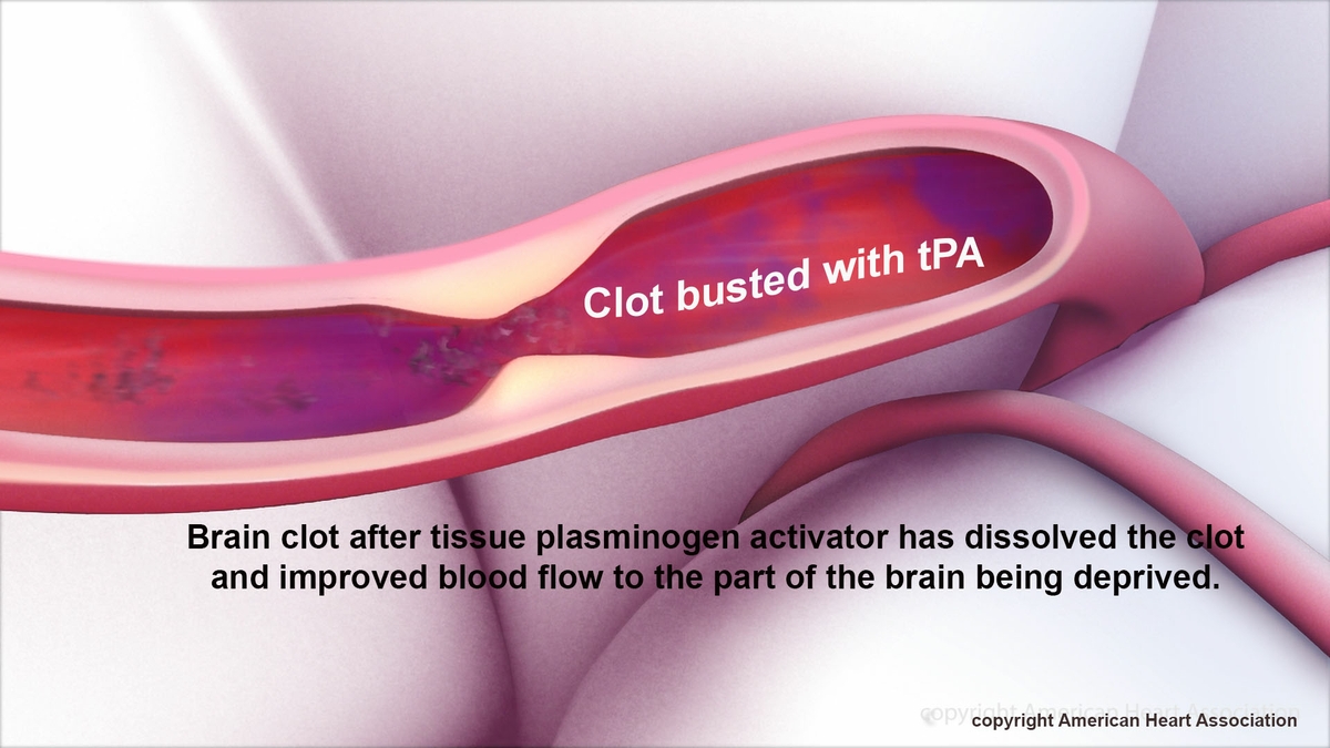 Clot busted with tPA 