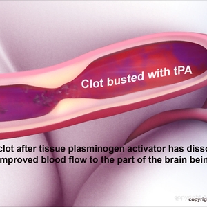 Clot busted with tPA 