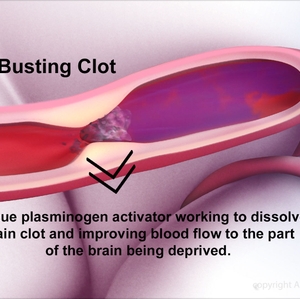 Clot busting tPA administered infographic