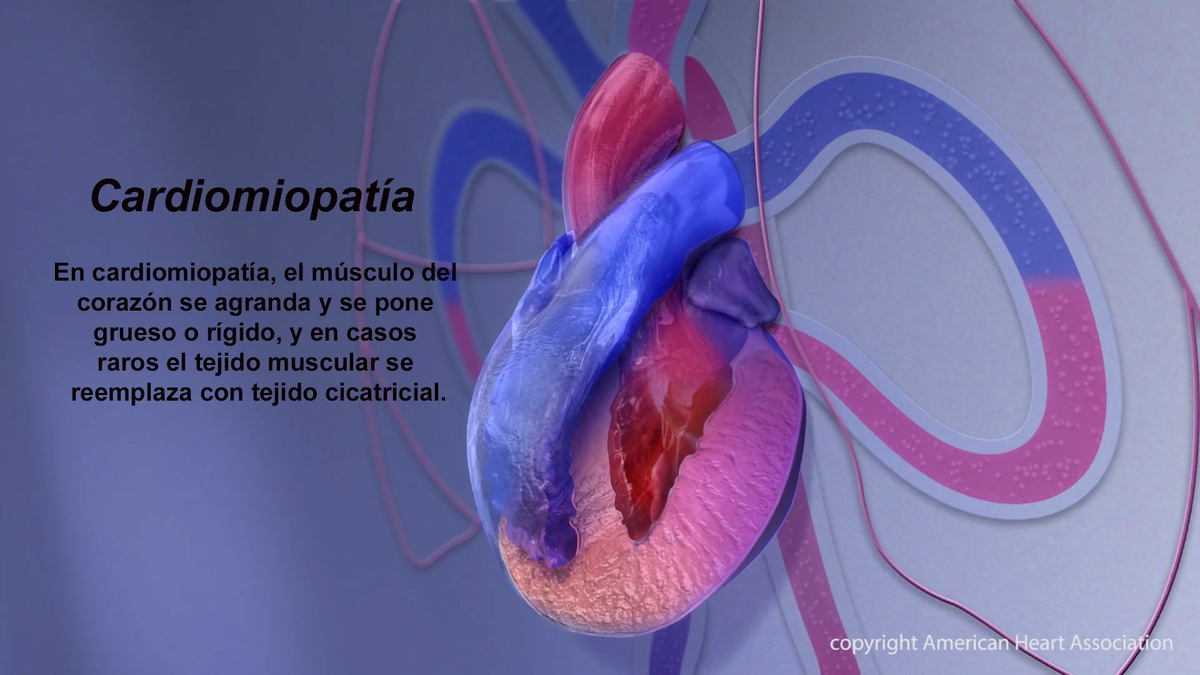 Cardiomyopathy - Spanish