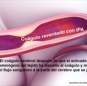 Clot busted with tPA - Spanish