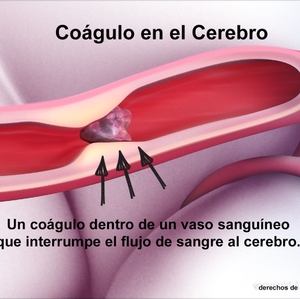 Clot in brain - Spanish