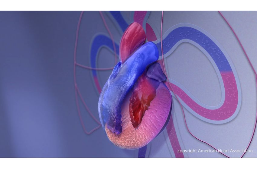 La Asociación Americana del Corazón impulsa avances en el diagnóstico de la miocardiopatía hipertrófica