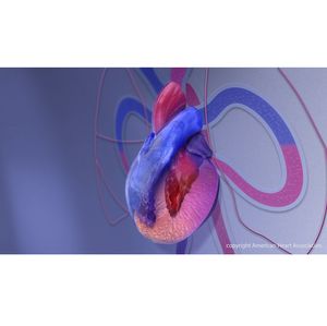 Expanded effort will help standardize, improve care for hypertrophic cardiomyopathy