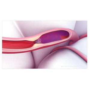 Newer generation, clot-busting stroke medication cuts the risk of serious bleeding in half