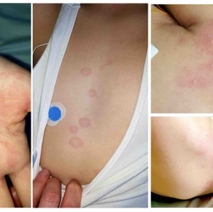 Immunotherapy, steroids had positive outcomes in children with COVID-related multi-system inflammatory syndrome 