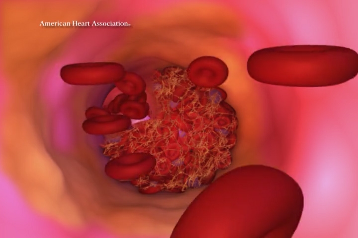Atherosclerosis blockage forming graphic