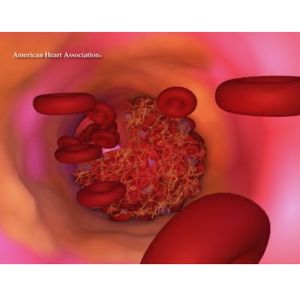 New program for veterans with high cholesterol, associated cardiovascular disease