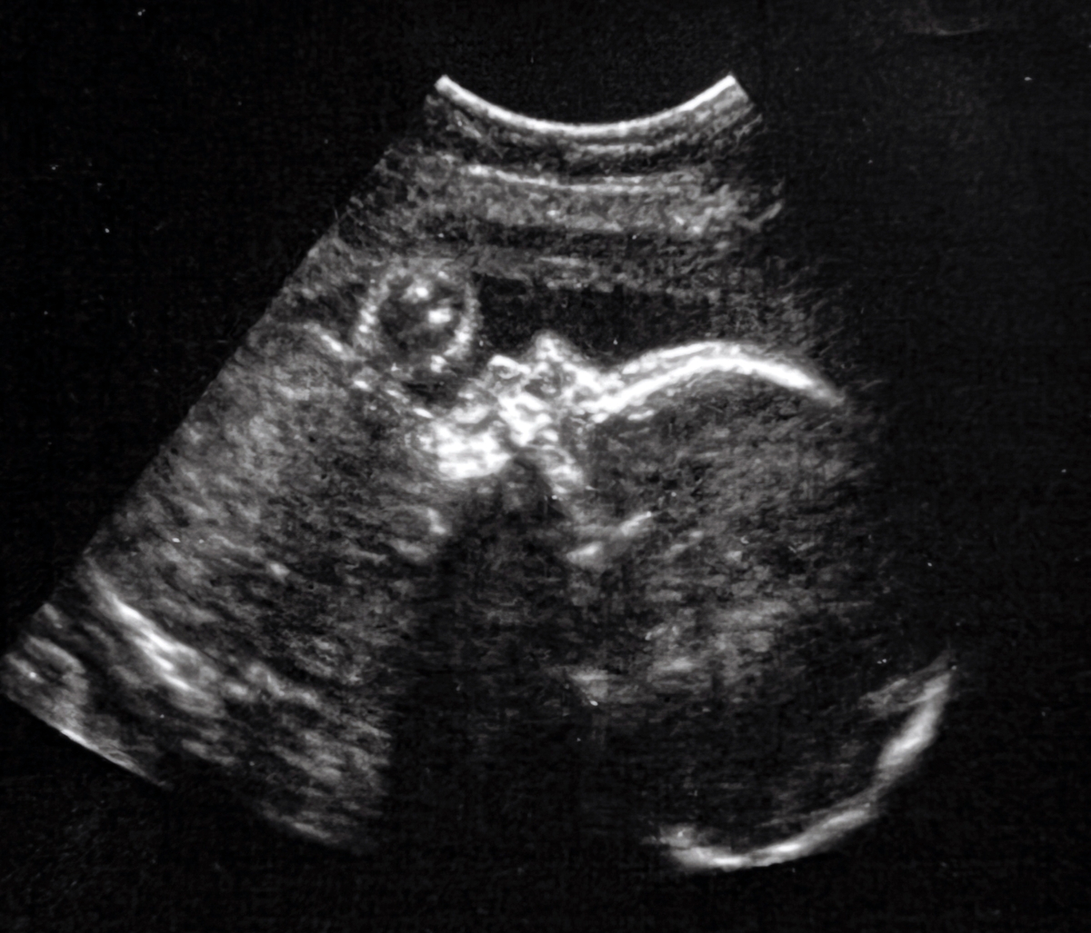 Healthy baby in-utero