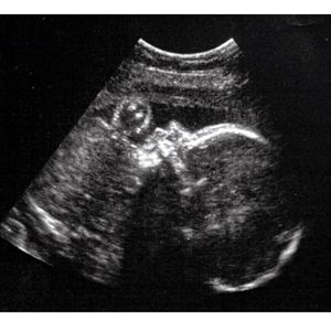 In first in-utero brain surgery, doctors eliminated symptoms of dangerous condition